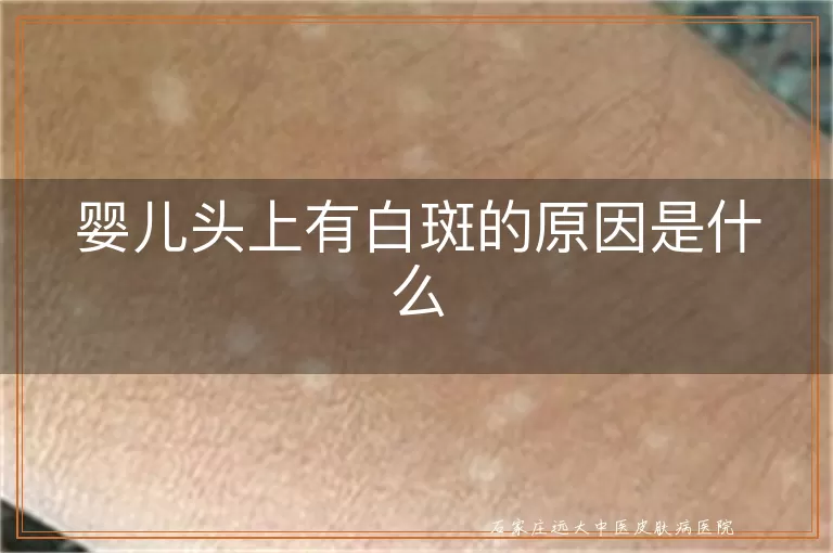 婴儿头上有白斑的原因是什么