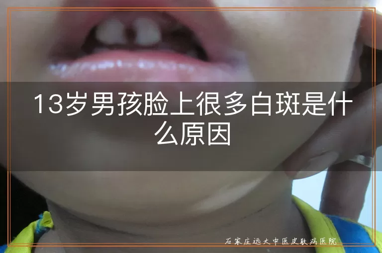 13岁男孩脸上很多白斑是什么原因