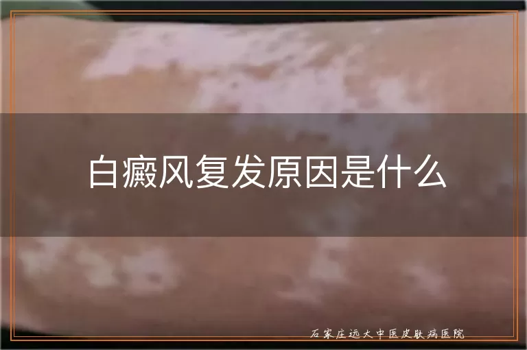 白癜风复发原因是什么