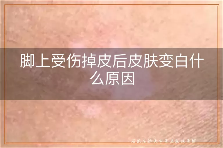 脚上受伤掉皮后皮肤变白什么原因