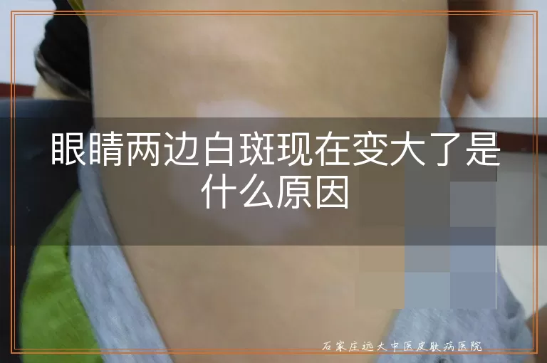 眼睛两边白斑现在变大了是什么原因