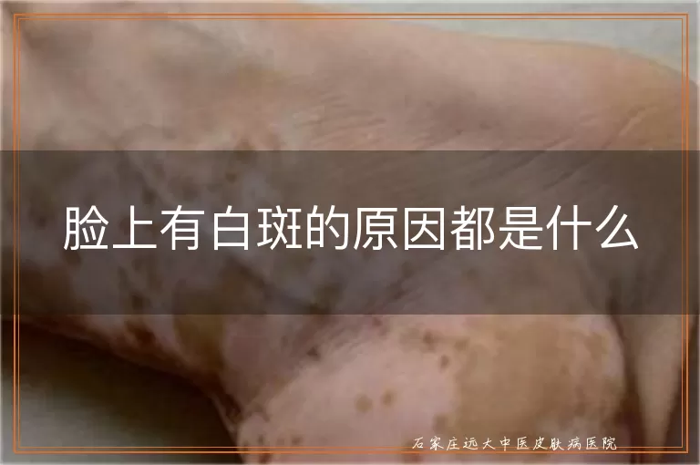 脸上有白斑的原因都是什么