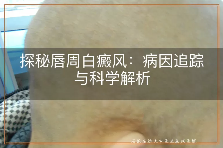 探秘唇周白癜风:病因追踪与科学解析