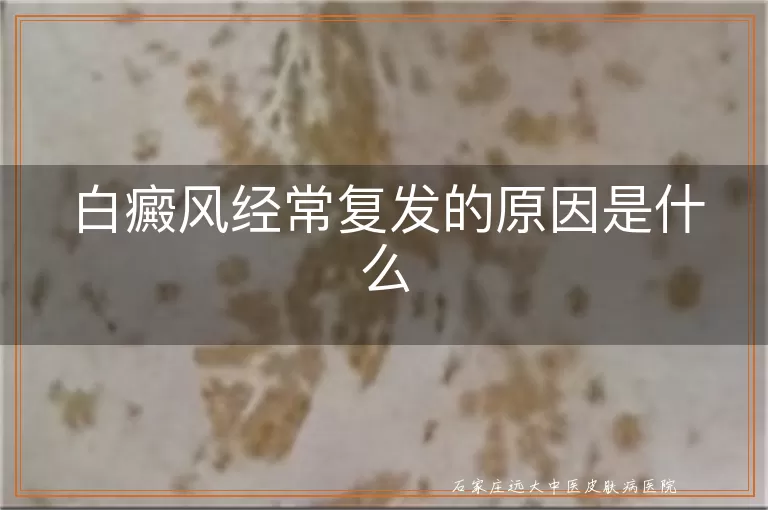 白癜风经常复发的原因是什么
