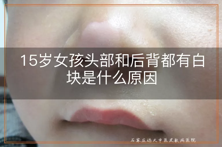 15岁女孩头部和后背都有白块是什么原因