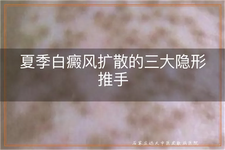 夏季白癜风扩散的三大隐形推手
