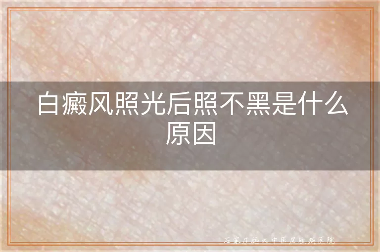 白癜风照光后照不黑是什么原因