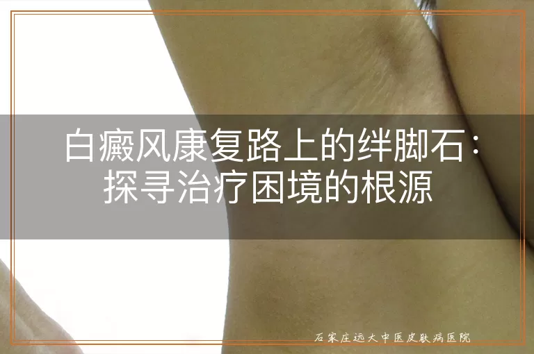 白癜风康复路上的绊脚石:探寻治疗困境的根源