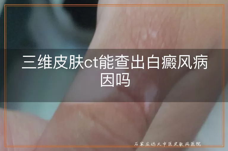 三维皮肤ct能查出白癜风病因吗