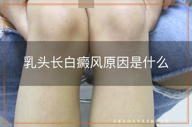 乳头长白癜风原因是什么