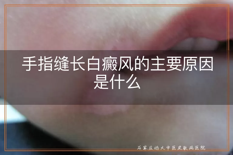 手指缝长白癜风的主要原因是什么