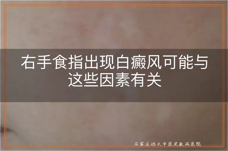 右手食指出现白癜风可能与这些因素有关