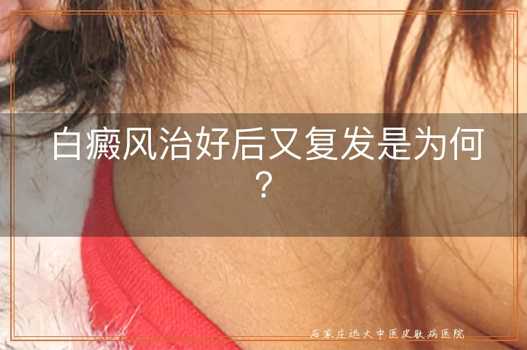 白癜风治好后又复发是为何？
