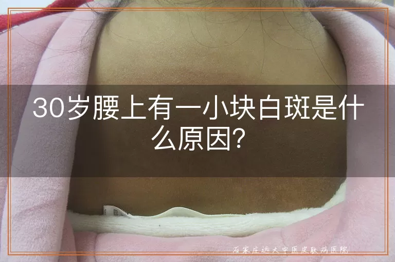 30岁腰上有一小块白斑是什么原因？