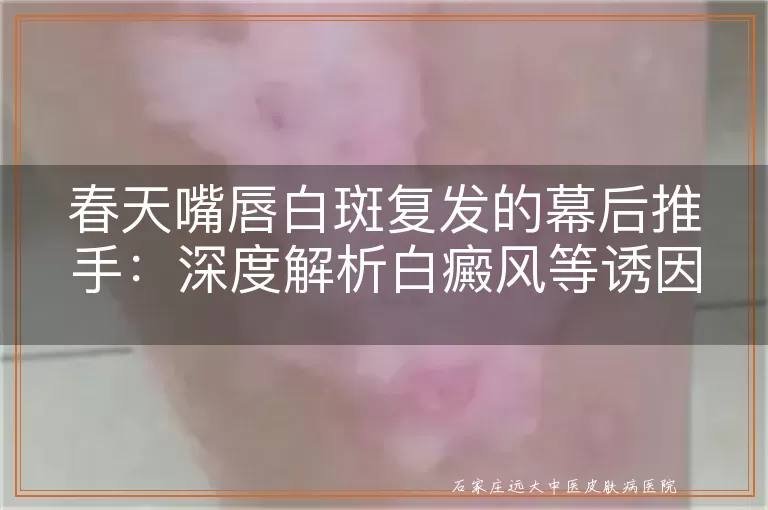 春天嘴唇白斑复发的幕后推手：深度解析白癜风等诱因