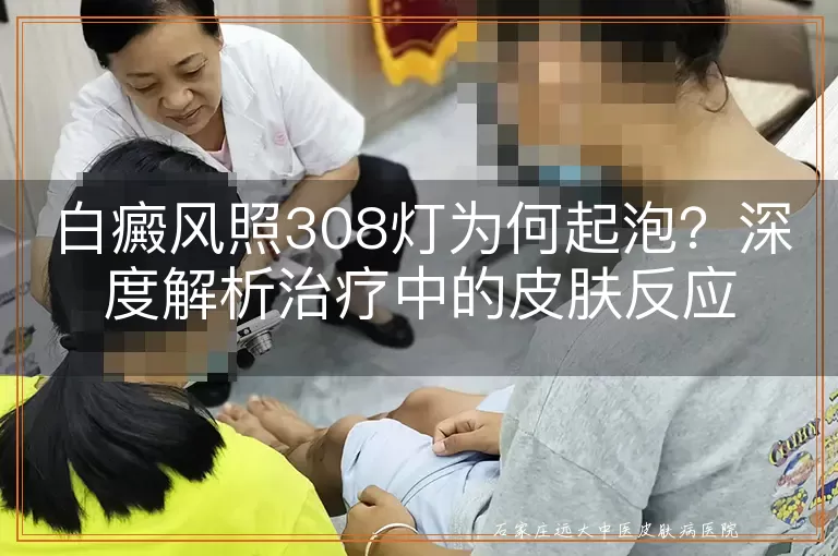 白癜风照308灯为何起泡?深度解析治疗中的皮肤反应