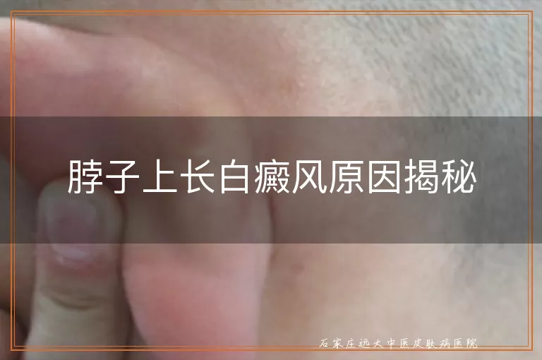 脖子上长白癜风原因揭秘