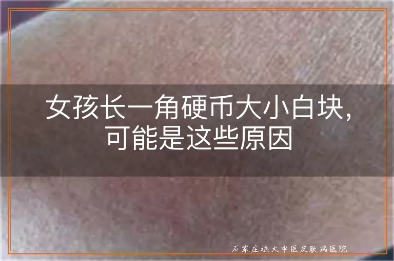 女孩长一角硬币大小白块，可能是这些原因