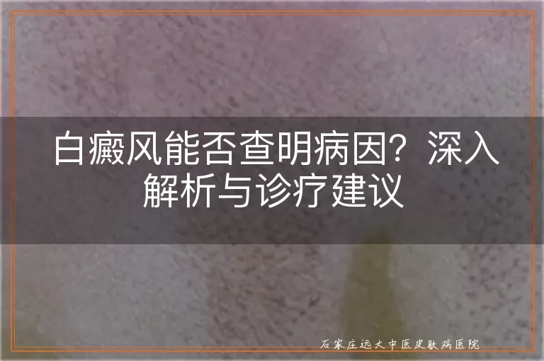 白癜风能否查明病因?深入解析与诊疗建议