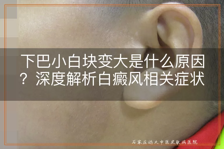 下巴小白块变大是什么原因？深度解析白癜风相关症状