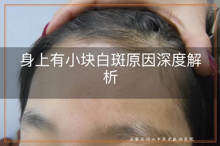 身上有小块白斑原因深度解析
