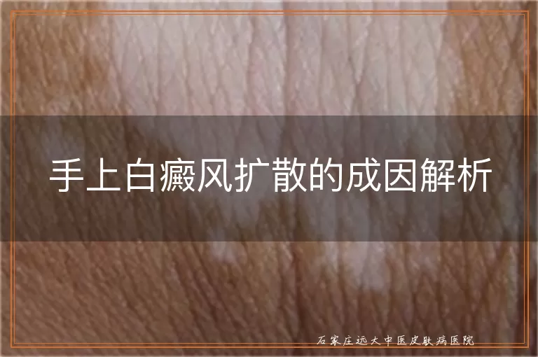 手上白癜风扩散的成因解析