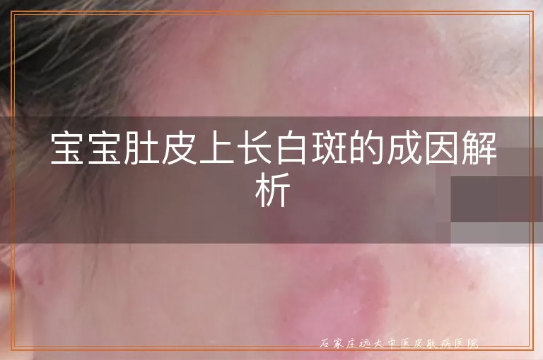 宝宝肚皮上长白斑的成因解析