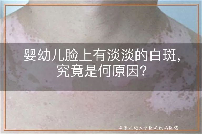 婴幼儿脸上有淡淡的白斑，究竟是何原因？