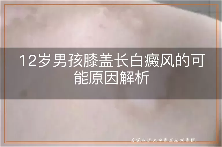 12岁男孩膝盖长白癜风的可能原因解析