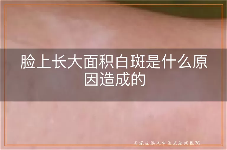 脸上长大面积白斑是什么原因造成的