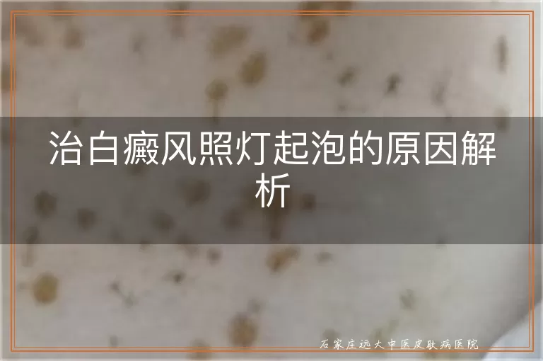 治白癜风照灯起泡的原因解析
