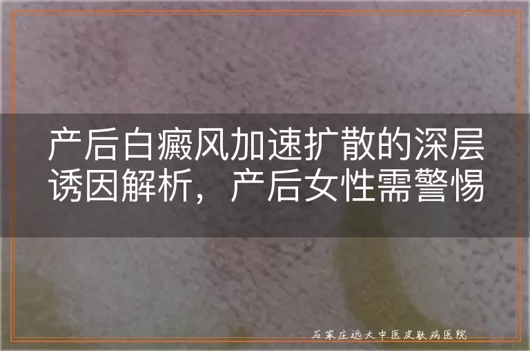产后白癜风加速扩散的深层诱因解析，产后女性需警惕的三大风险