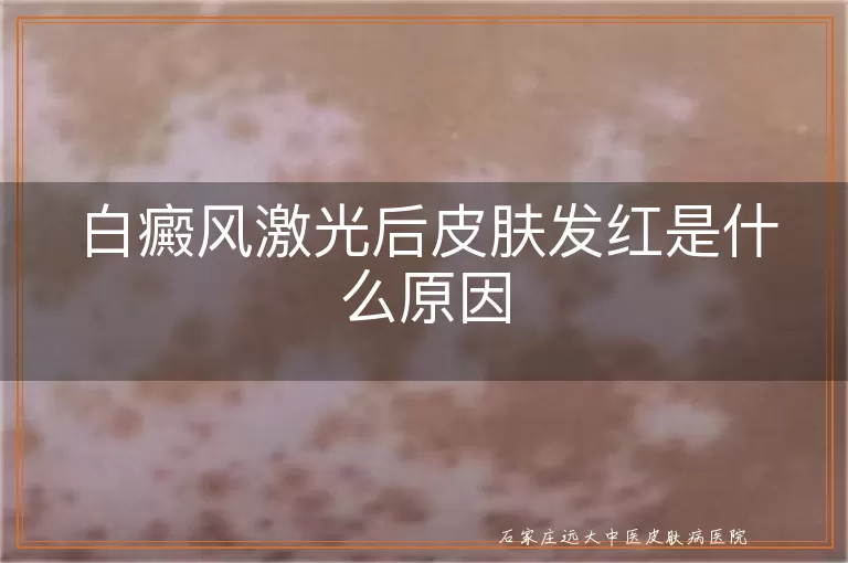 白癜风激光后皮肤发红是什么原因