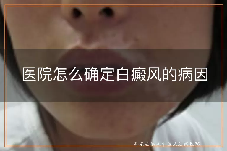 医院怎么确定白癜风的病因
