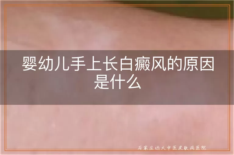 婴幼儿手上长白癜风的原因是什么