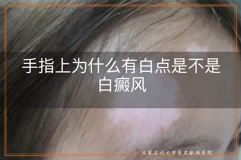 手指上为什么有白点是不是白癜风