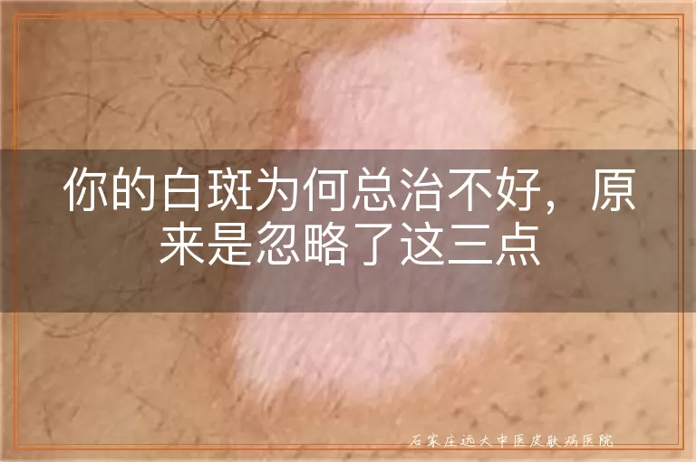 你的白斑为何总治不好，原来是忽略了这三点