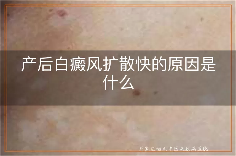 产后白癜风扩散快的原因是什么