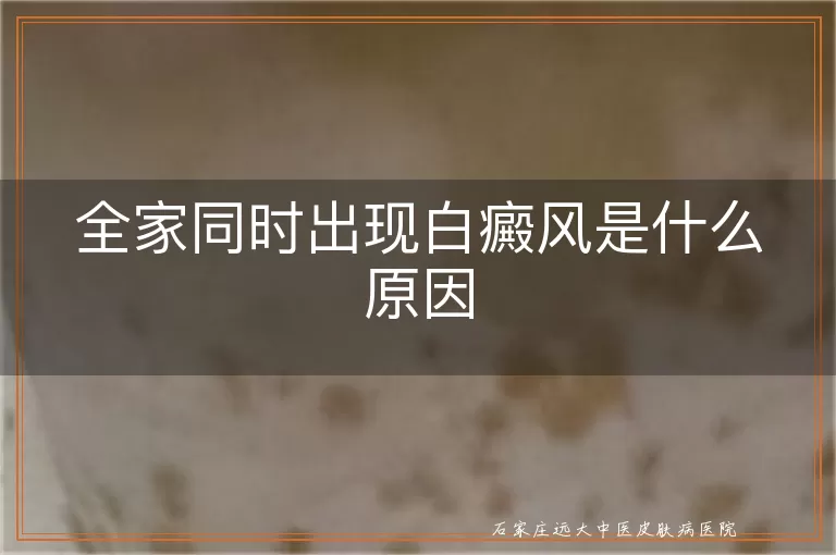 全家同时出现白癜风是什么原因