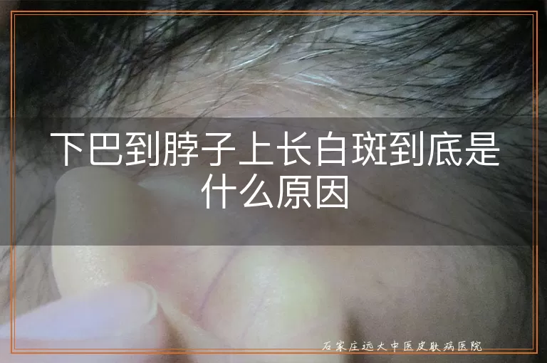 下巴到脖子上长白斑到底是什么原因