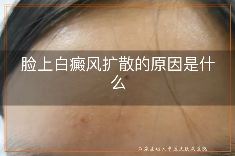 脸上白癜风扩散的原因是什么