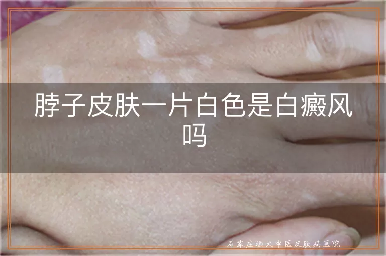 脖子皮肤一片白色是白癜风吗