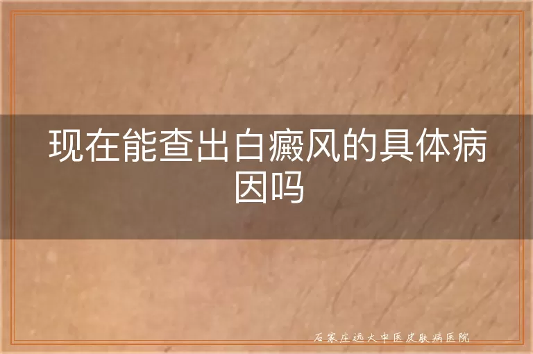现在能查出白癜风的具体病因吗