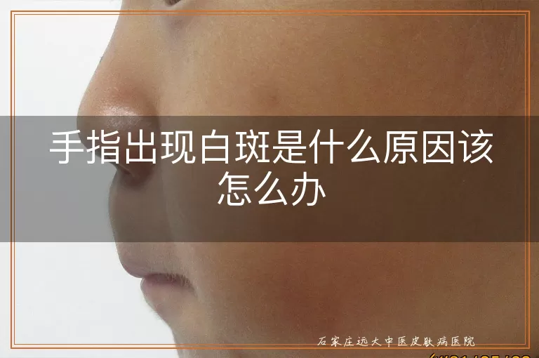 手指出现白斑是什么原因该怎么办