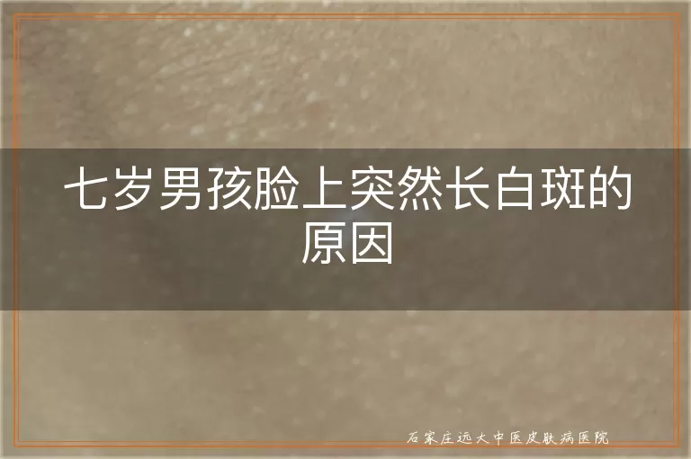 七岁男孩脸上突然长白斑的原因