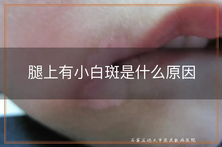 腿上有小白斑是什么原因