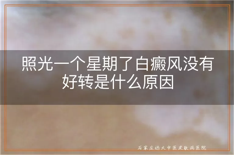 照光一个星期了白癜风没有好转是什么原因
