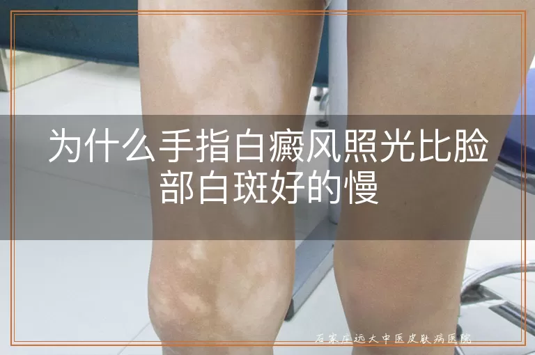 为什么手指白癜风照光比脸部白斑好的慢