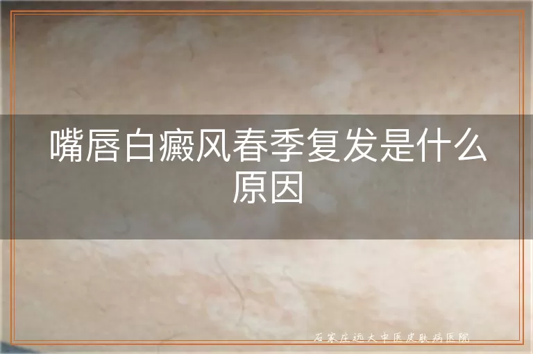 嘴唇白癜风春季复发是什么原因
