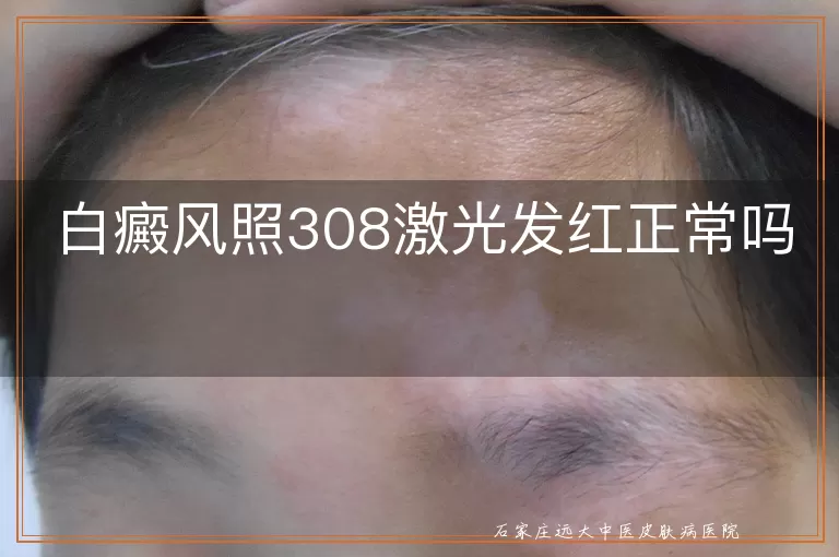 白癜风照308激光发红正常吗